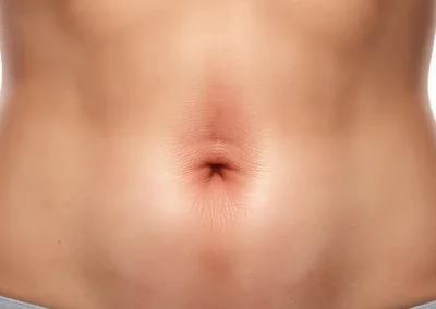 Cicatriz Abdominal