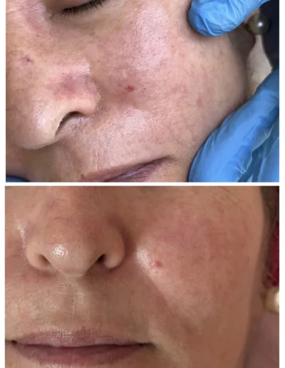Resultados ProFacial inmediatos
