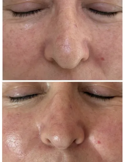 Resultados ProFacial inmediatos